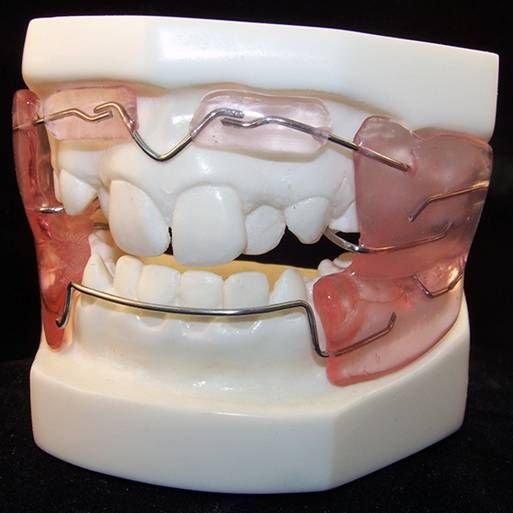 Colocacion-de-brackets